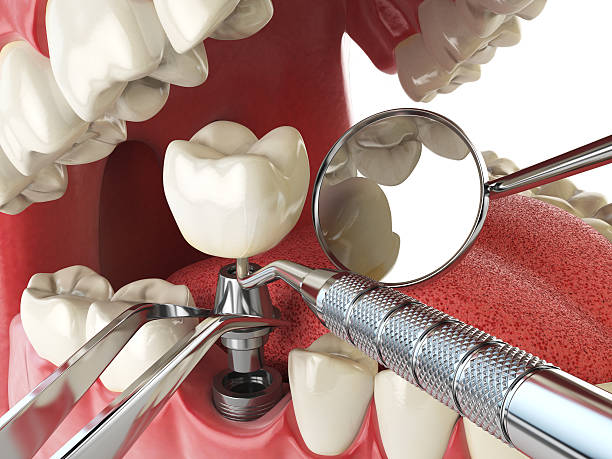 Best Emergency Dentist for Lost Fillings or Crowns in Sunriver, OR