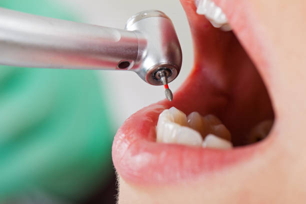Best Emergency Dentist for Knocked-Out Tooth in Sunriver, OR